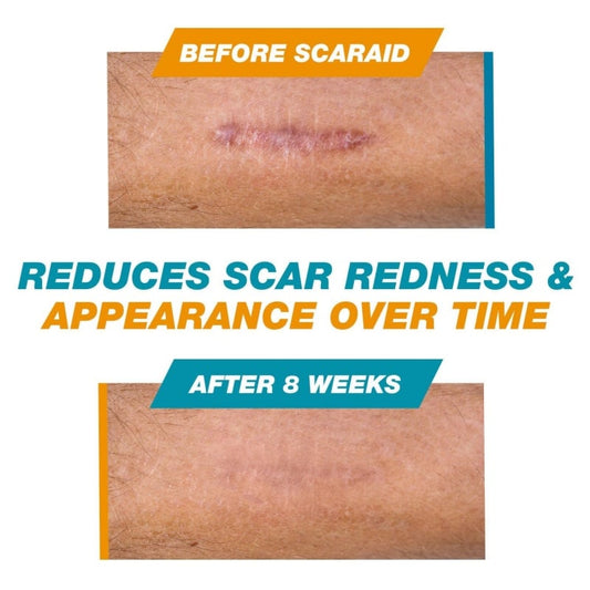 Skin Scar Solutions🛡️ 60% Silicone Scar Stick.