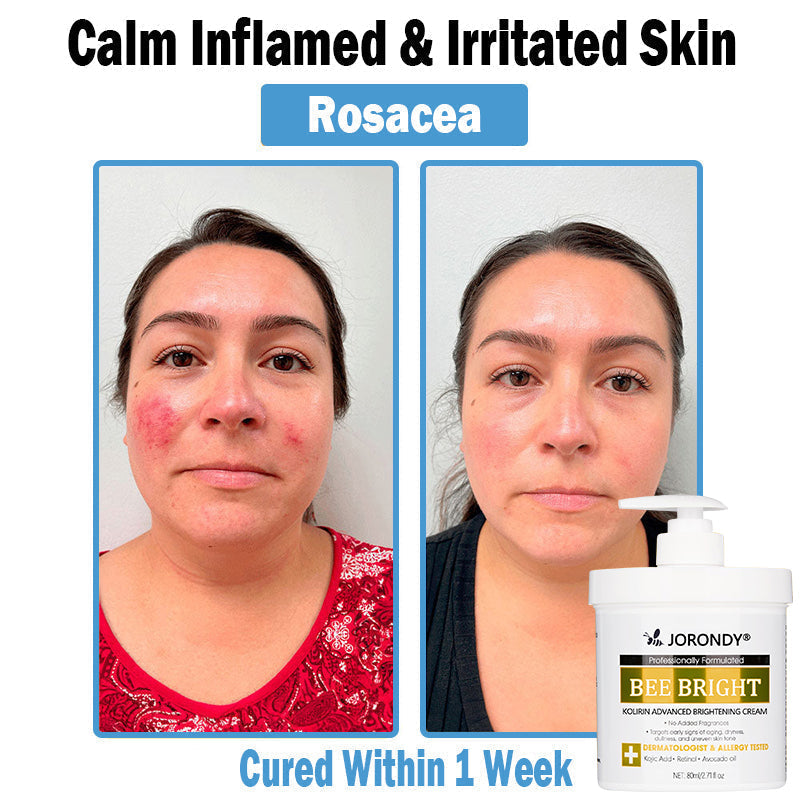 𝗝𝗼𝗿𝗼𝗻𝗱𝘆® Bee Bright Multi-Symptom Skin Treatment Cream